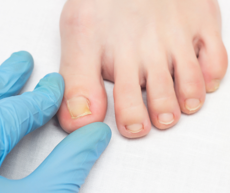 How to Sidestep Ingrown Toenails (And What to Do If You Can’t!)