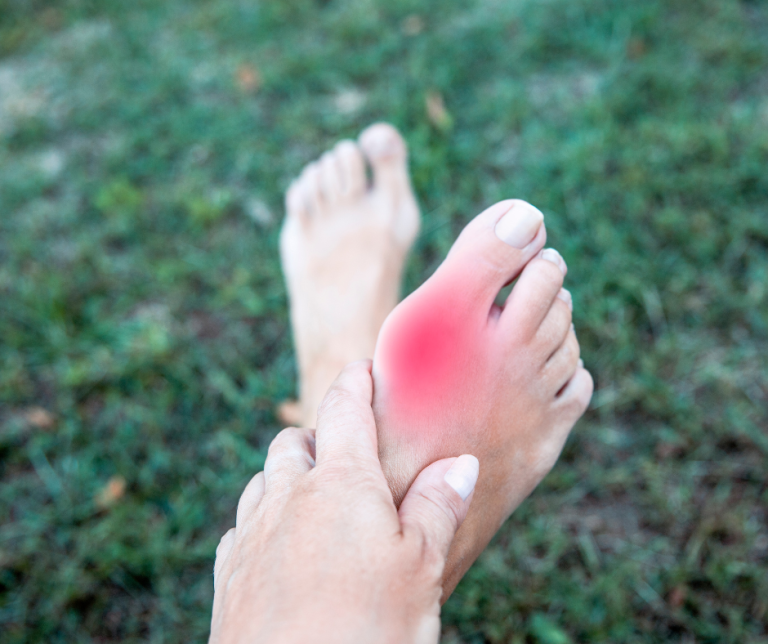 Feet in front of grass with legs crossed and large bunion on right foot sticking out of left side of it