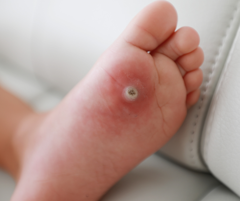 Foot with plantar warts